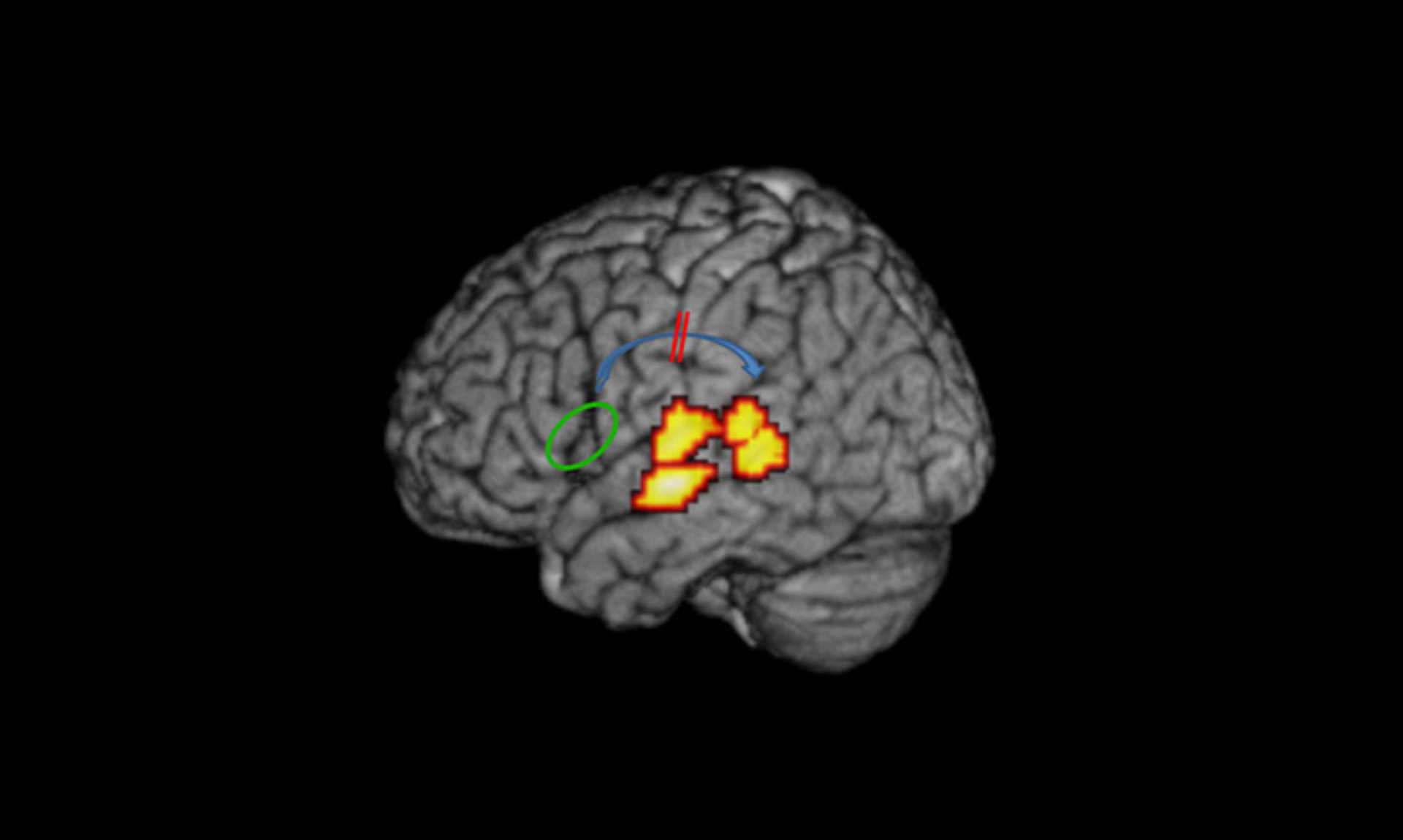 Belgian Study Finds Possible Cause of Dyslexia
