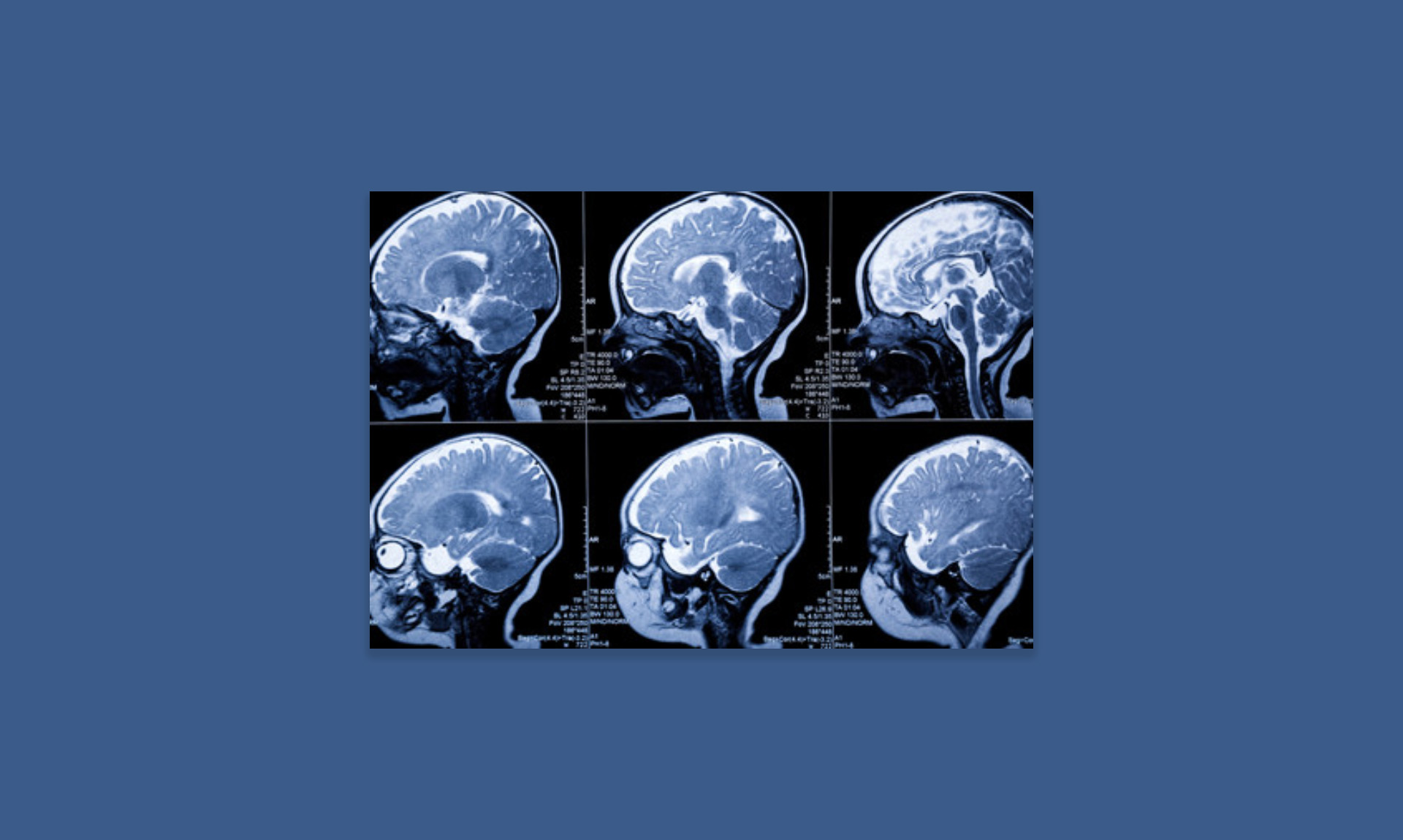 Tackling the Early Identification of Dyslexia with the Help of Neuroimaging